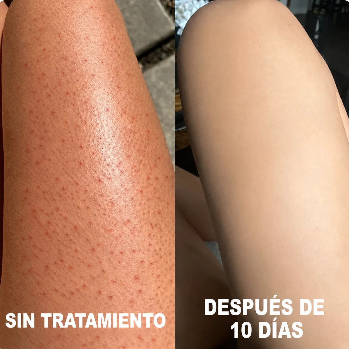 Resultado visual en piernas: sin tratamiento y después de 10 días